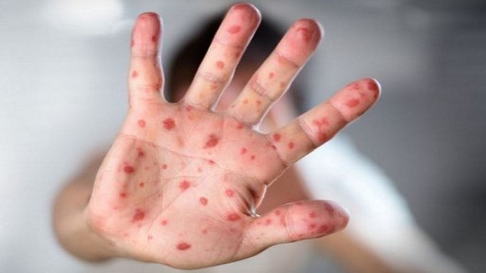 হাম ও উপসর্গ নিয়ে আরও ১১ জনের মৃত্যু